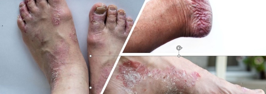 Le Psoriasis au niveau du pied