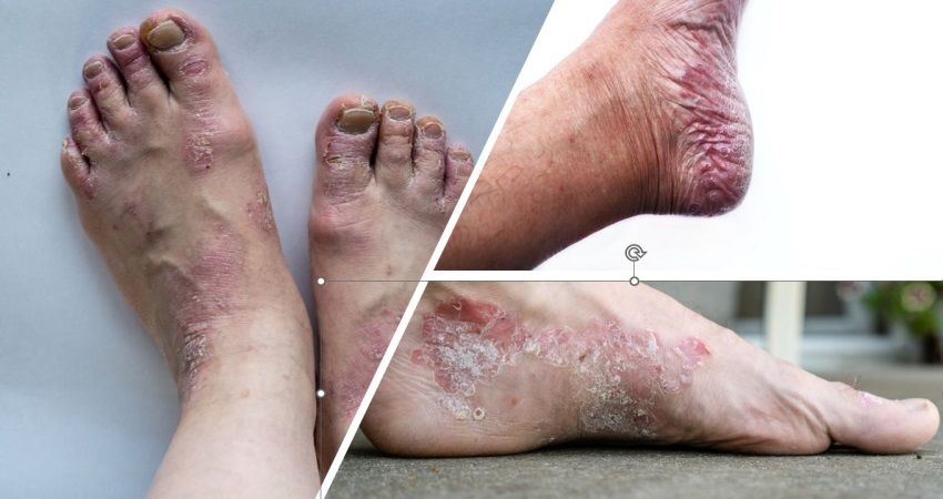 Le Psoriasis au niveau du pied