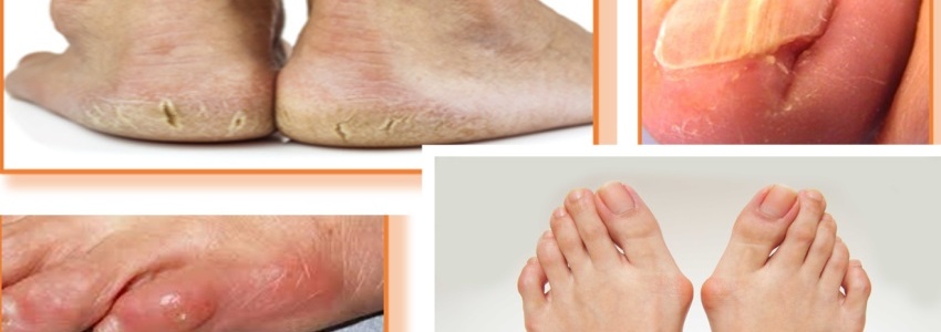Les pathologies des pieds