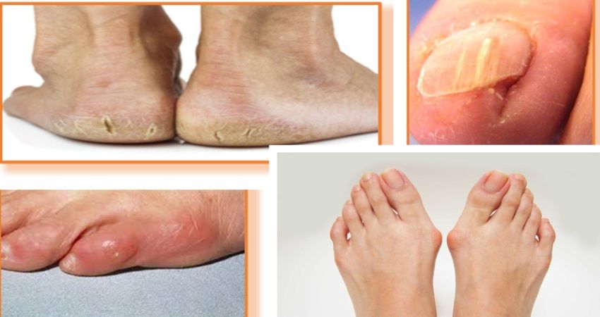 Les pathologies des pieds